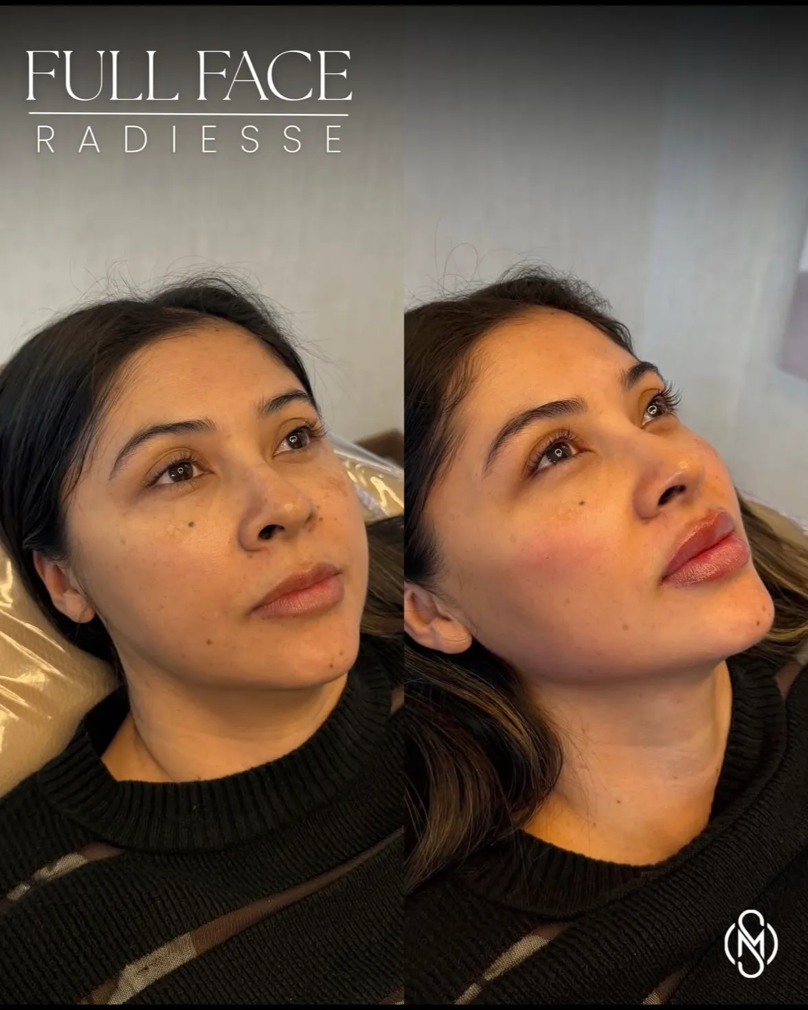Comparativa de una misma paciente en dos retratos de tres cuartos: a la izquierda antes del tratamiento y a la derecha después. El arte lleva impreso el rótulo «Full Face Radiesse».