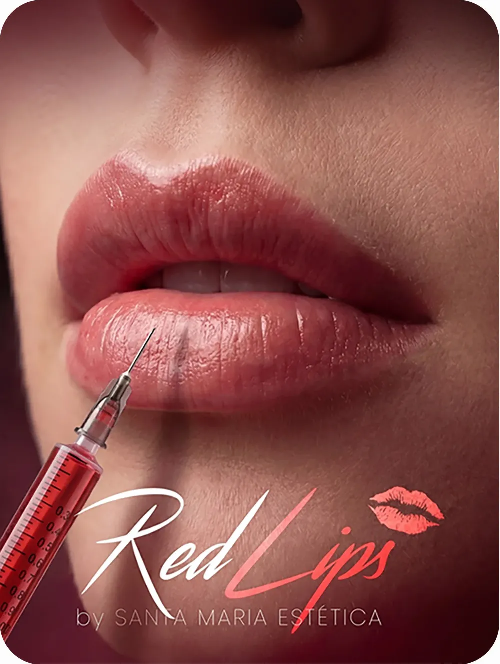 Red Lips by Santa María Estética, tratamiento de armonización de labios.