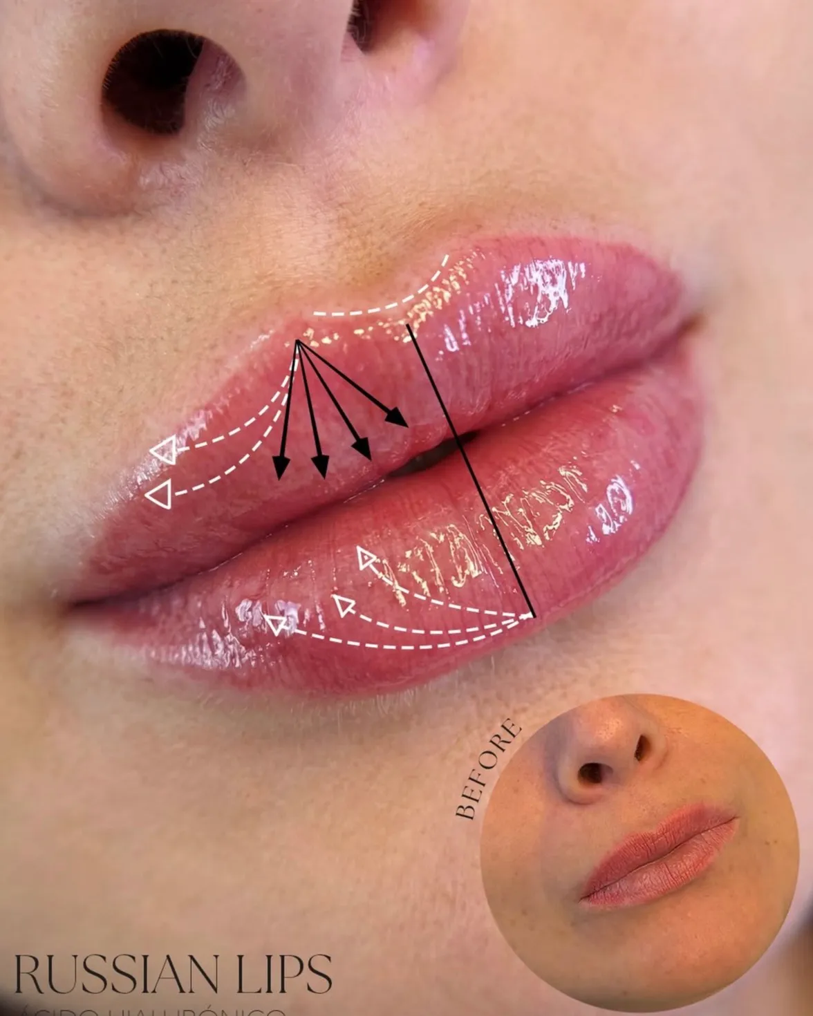 Primer plano de unos labios después del tratamiento, con flechas dibujadas sobre la foto indicando los puntos de inyección y un medallón circular con los labios de antes. Rótulo «Russian Lips, ácido hialurónico».